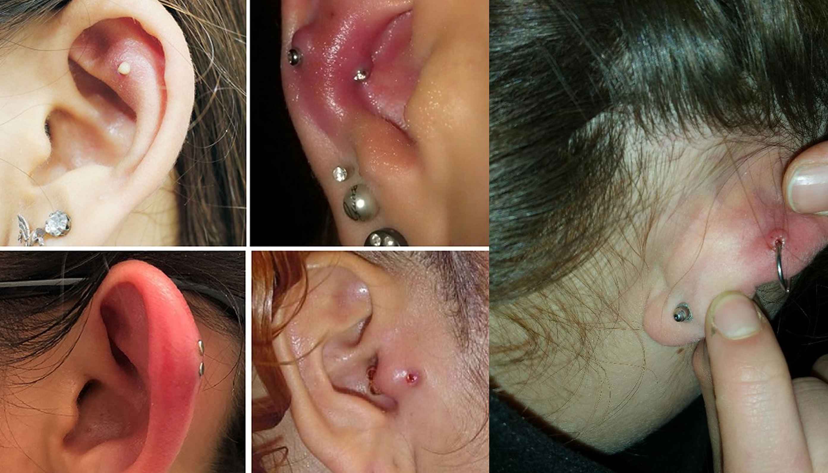 Küpe Deliği İltihabı Nasıl Geçer? Doğal Yöntemlerle Tedavi Rehberi